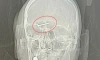 Петербургские врачи достали из головы пациента металлический саморез и резиновый шарик