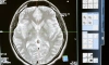 Российские ученые обнаружили аномалии в головном мозгу переболевших COVID-19