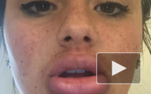 Адский флэшмоб #kyliejennerchallenge калечит участников, но люди продолжают уродовать себя