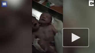 Появилось видео двухголового младенца, который родился в Индии