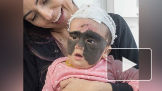 Мама девочки с родимым пятном на все лицо показала результат операций в Краснодаре 